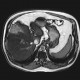 Liver metastasis of adenocarcinoma of colon, colorectal carcinoma, biopsy: MRI - Magnetic Resonance Imaging